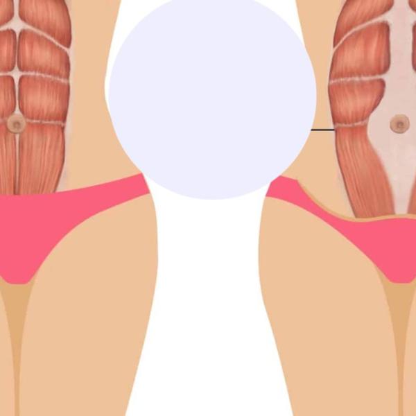 Come capire se si soffre di diastasi addominale, come si cura e quando è necessario l’intervento