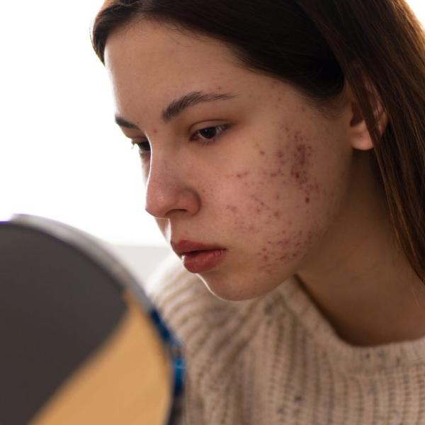 Quanti tipi di acne esistono e cosa fare in ogni specifico caso