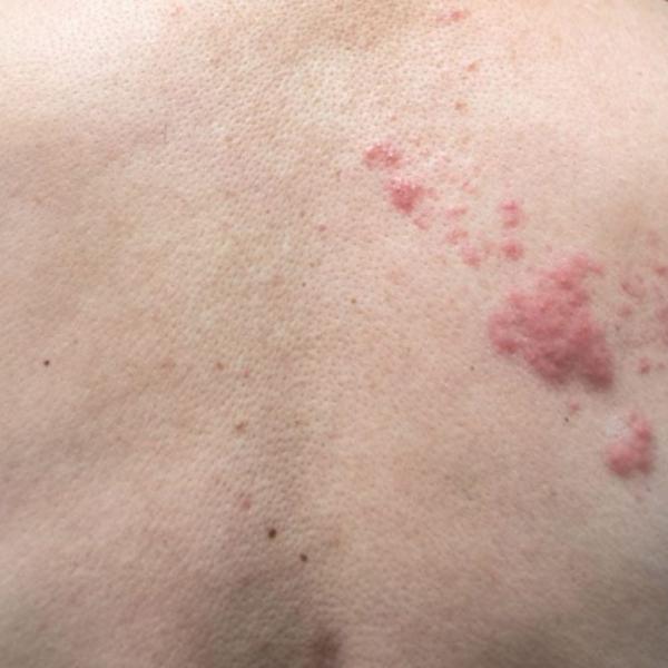 Come riconoscere e prevenire i sintomi dell’herpes zoster