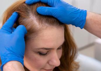 Cosa fare in caso di alopecia femminile, come arrestare la caduta dei capelli e a chi rivolgersi