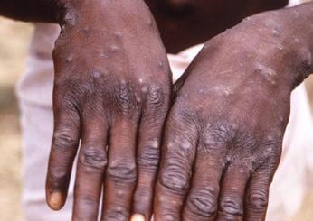 Vaiolo delle scimmie, perché l’Africa dichiara emergenza sanitaria e da dove è partita l’epidemia?