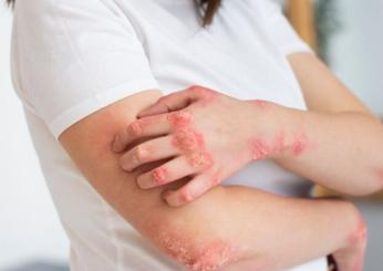 Ecco le differenze tra eczema e pelle secca, e come trattare entrambi