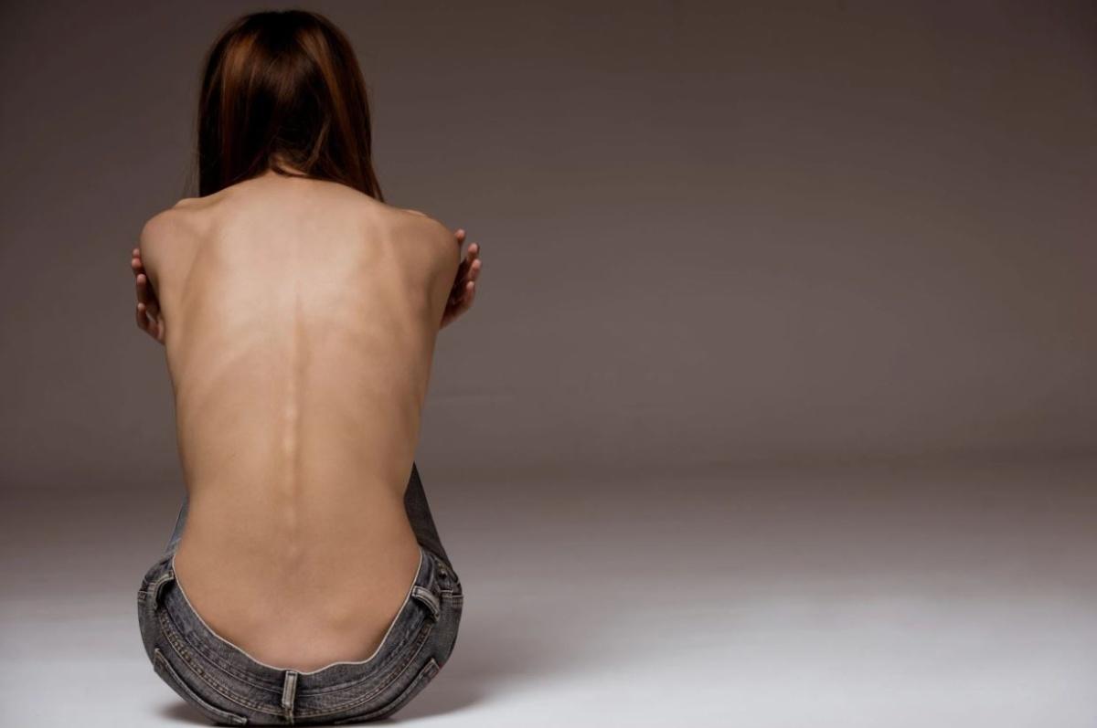 Quali sono i segnali dell’anoressia nervosa e i trattamenti che funzionano