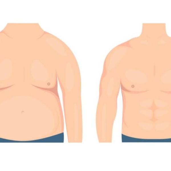 La ginecomastia si può risolvere senza intervento chirurgico? Ecco come ridurre questo disagio