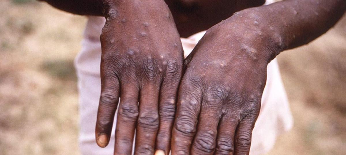 Vaiolo delle scimmie, perché l’Africa dichiara emergenza sanitaria e da dove è partita l’epidemia?