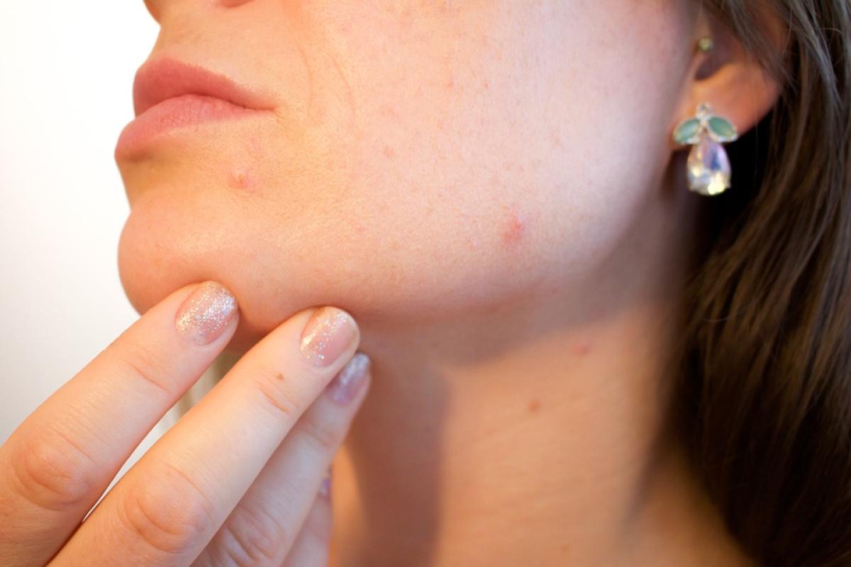 Cosa mangiare per combattere l’acne