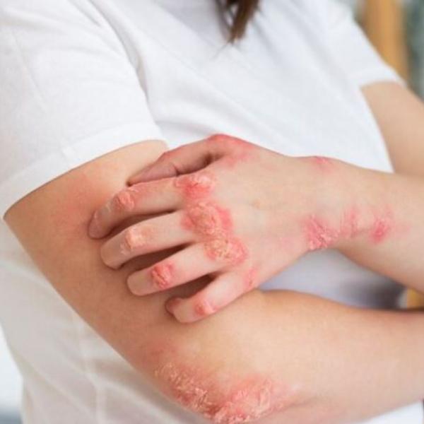 Ecco le differenze tra eczema e pelle secca, e come trattare entrambi