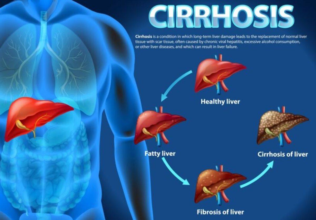 La cirrosi epatica è curabile? Quali sono i sintomi, da cosa è caus…