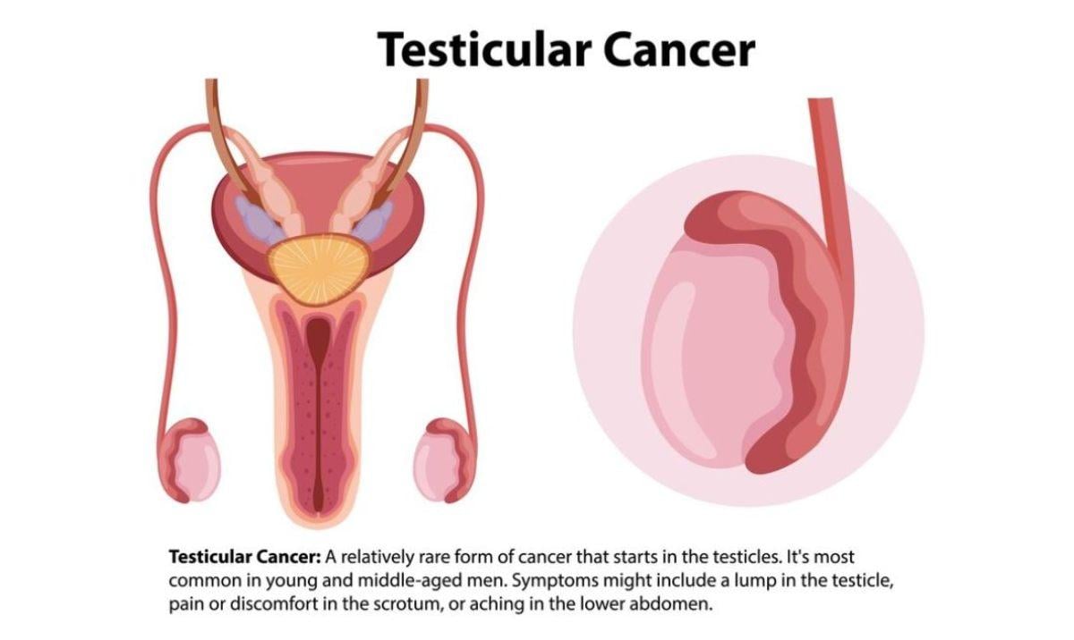 Tumore ai testicoli: sintomi iniziali e in stato avanzato, cause, m…