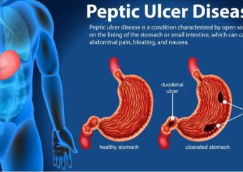 Come si cura l’ulcera peptica, quali sono i sintomi e come si diagnostica