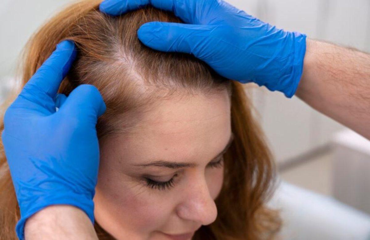 Cosa fare in caso di alopecia femminile, come arrestare la caduta dei capelli e a chi rivolgersi