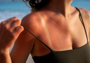 Come curare la pelle bruciata dal sole con i rimedi naturali?