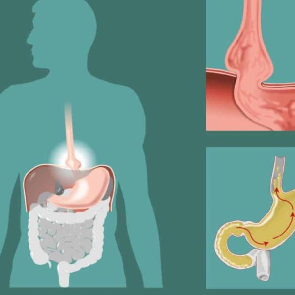 Quali sono i sintomi dell’ernia iatale, come si cura e quando può essere pericolosa