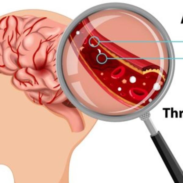 Cosa mangiare per prevenire un ictus? Ecco quali cibi scegliere e quanto spesso bisogna mangiare