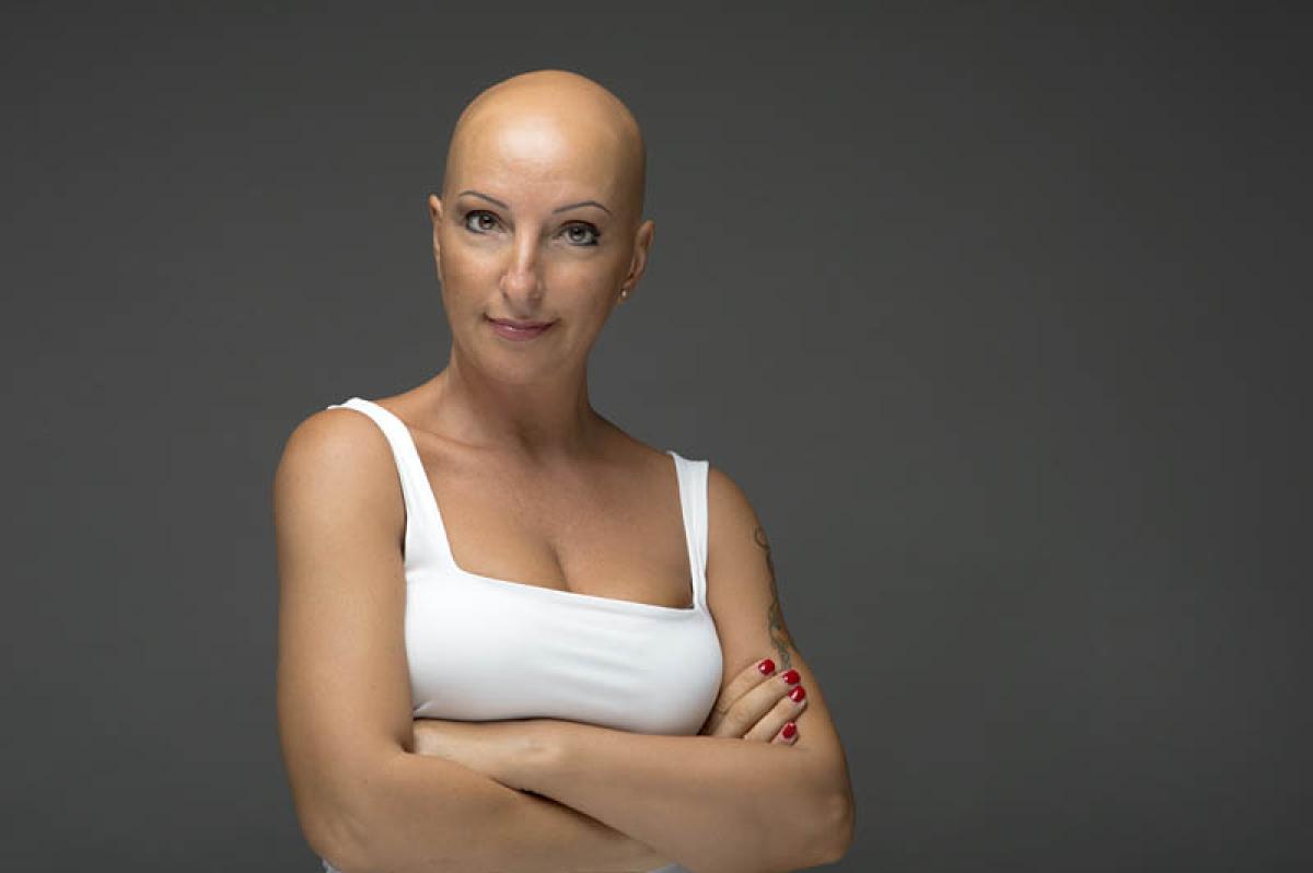 Alopecia: la malattia che non è riconosciuta dal sistema sanitario …