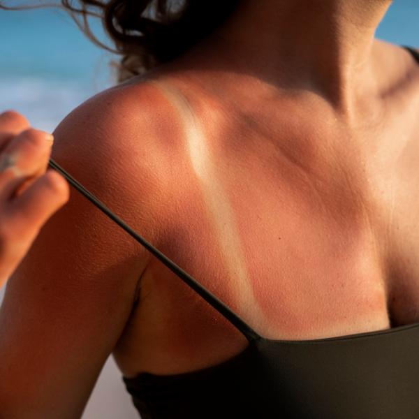 Come curare la pelle bruciata dal sole con i rimedi naturali?