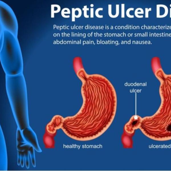 Come si cura l’ulcera peptica, quali sono i sintomi e come si diagnostica