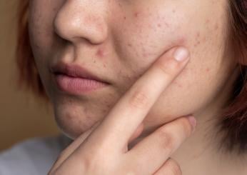 Perché chi fa sport ha i brufoli: come prevenire e curare l’acne dello sportivo