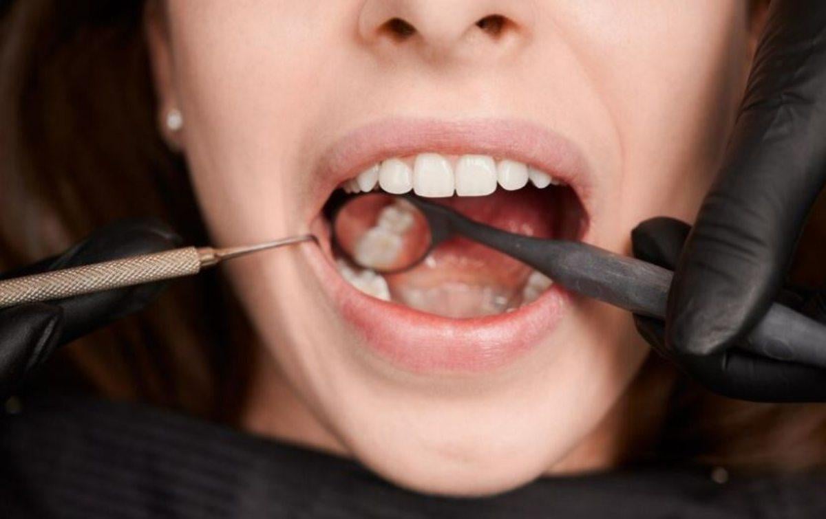 Quali alimenti macchiano i denti e cosa mangiare per avere denti più bianchi