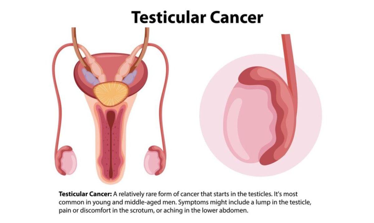 Tumore ai testicoli: sintomi iniziali e in stato avanzato, cause, mortalità e aspettativa di vita. Compromette l’erezione? Ecco quando preoccuparsi