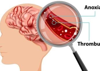 Cosa mangiare per prevenire un ictus? Ecco quali cibi scegliere e quanto spesso bisogna mangiare