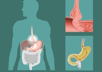 Quali sono i sintomi dell’ernia iatale, come si cura e quando può essere pericolosa