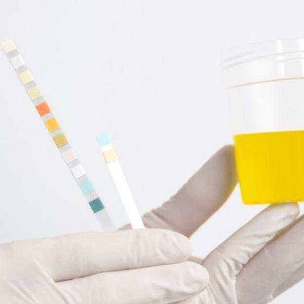 Scoperto nuovo test delle urine per diagnosticare cancro alla prostata aggressivo