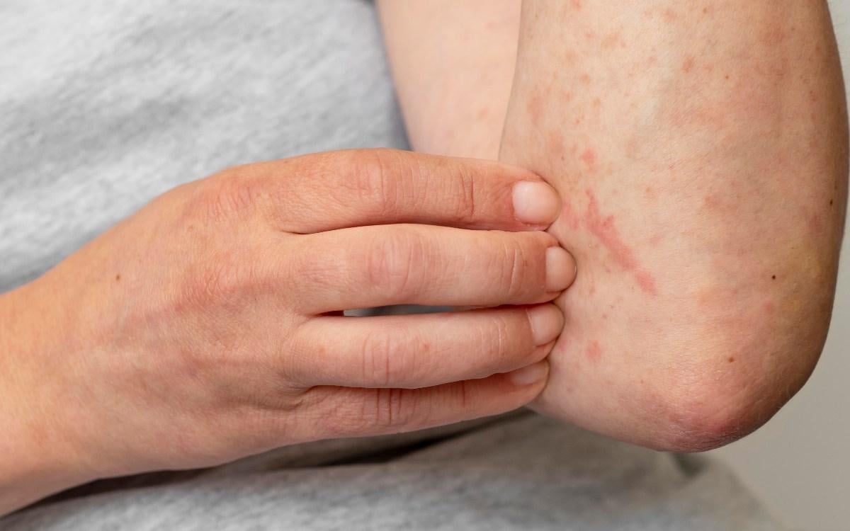 Consigli quotidiani per alleviare l’eczema e trovare sollievo