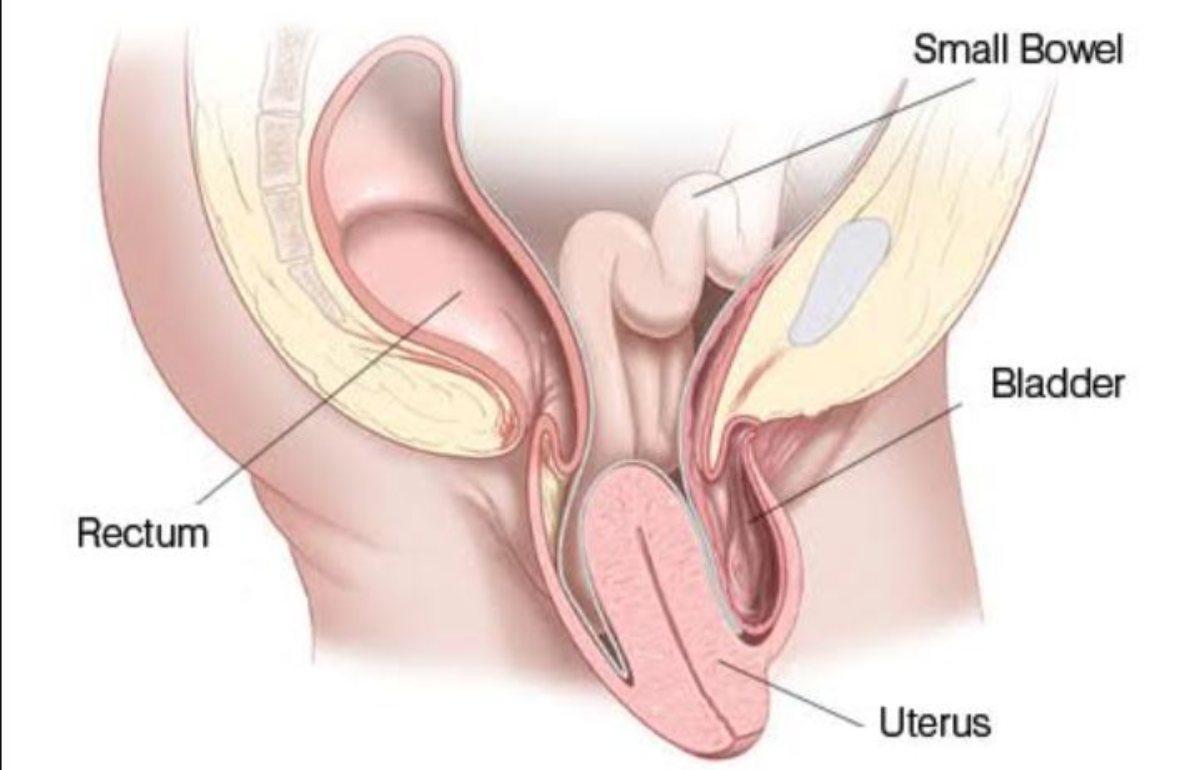 A cosa è dovuto il prolasso uterino, quali sono i sintomi, come si cura e quando è necessario operare