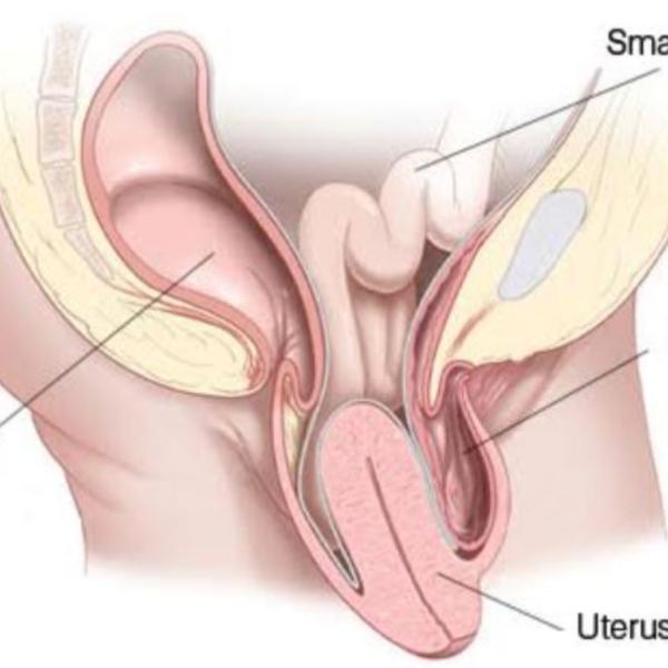 A cosa è dovuto il prolasso uterino, quali sono i sintomi, come si cura e quando è necessario operare