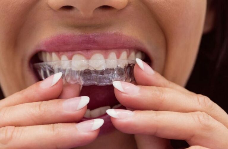 Digrignare i denti quali problemi può causare, a chi rivolgersi e cosa fare per smettere