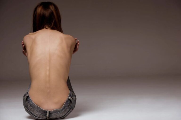 Quali sono i segnali dell'anoressia nervosa e i trattamenti che funzionano