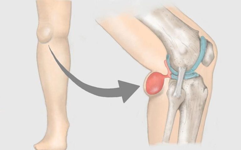 Che problemi può dare la cisti di Baker, come si cura e quando è necessario operarla