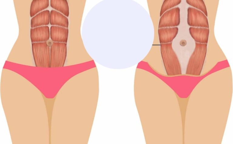 Come capire se si soffre di diastasi addominale, come si cura e quando è necessario l'intervento