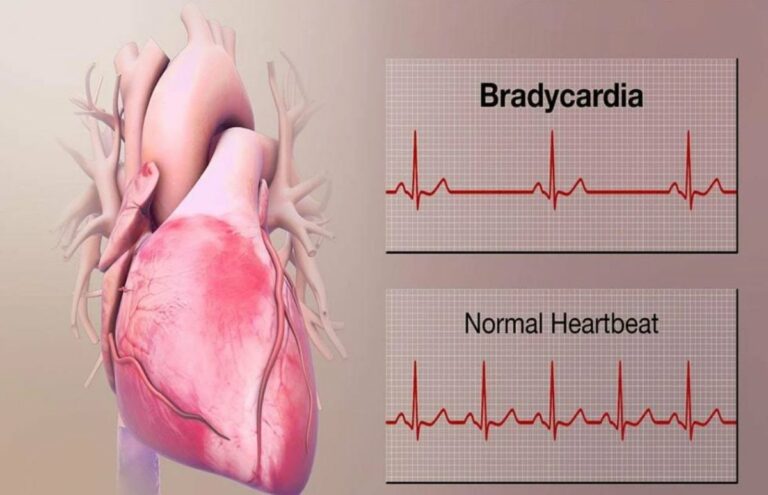 Quando la bradicardia sinusale è preoccupante e quali sono sintomi e cure