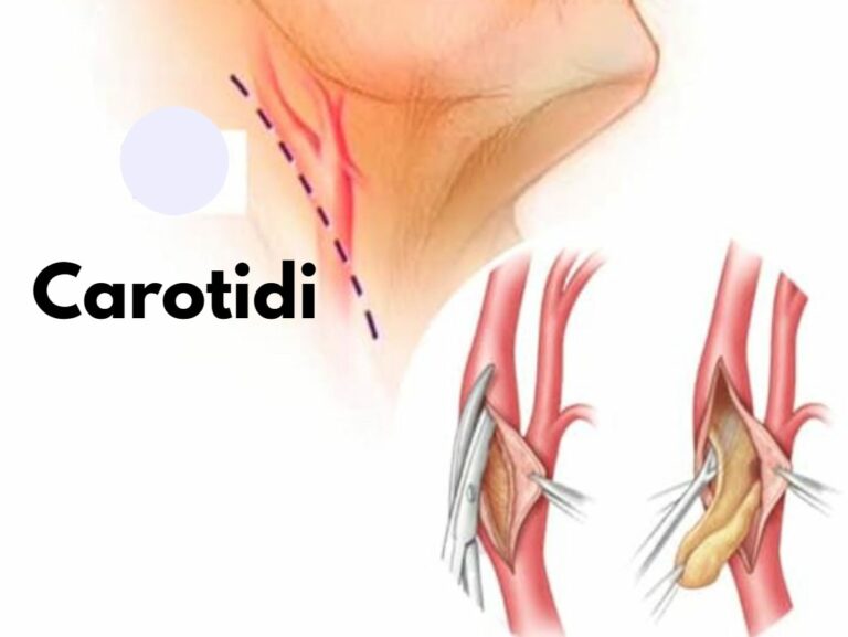 Cosa succede se si hanno le carotidi ostruite, quando preoccuparsi e quali sono i rischi