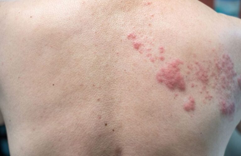 Come riconoscere e prevenire i sintomi dell'herpes zoster