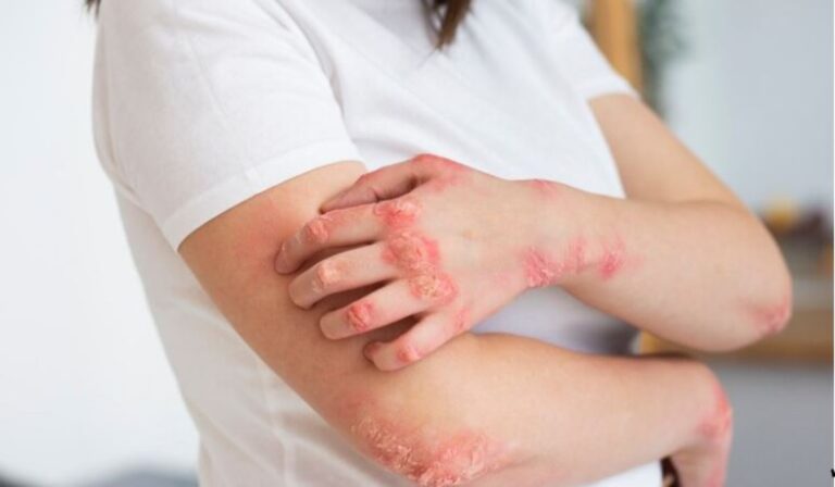 Ecco le differenze tra eczema e pelle secca, e come trattare entrambi